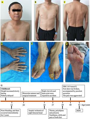 Case Report: A novel WRN mutation in Werner syndrome patient with diabetic foot disease and myelodysplastic syndrome